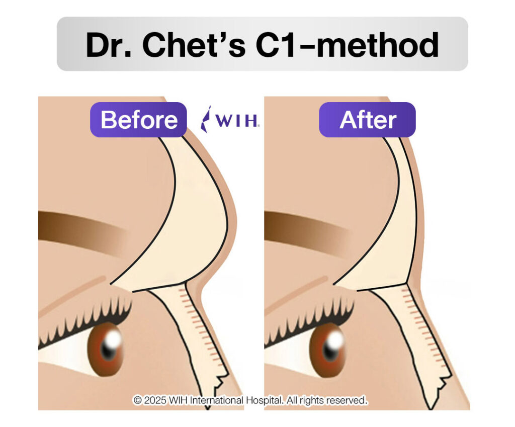 Brow Ridge Reduction (FFS): Frontal Sinus Setback