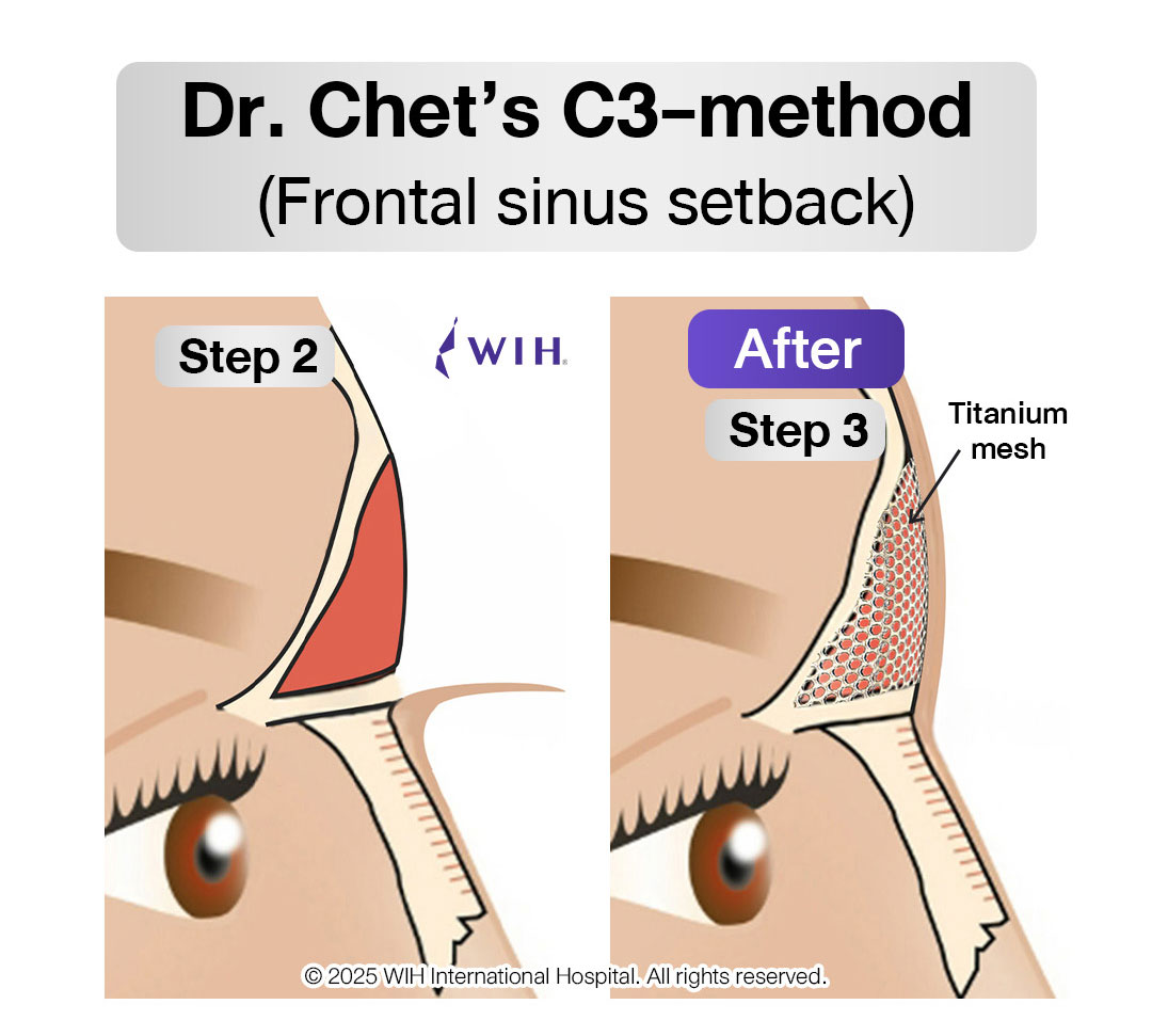 Brow ridge reduction Thailand