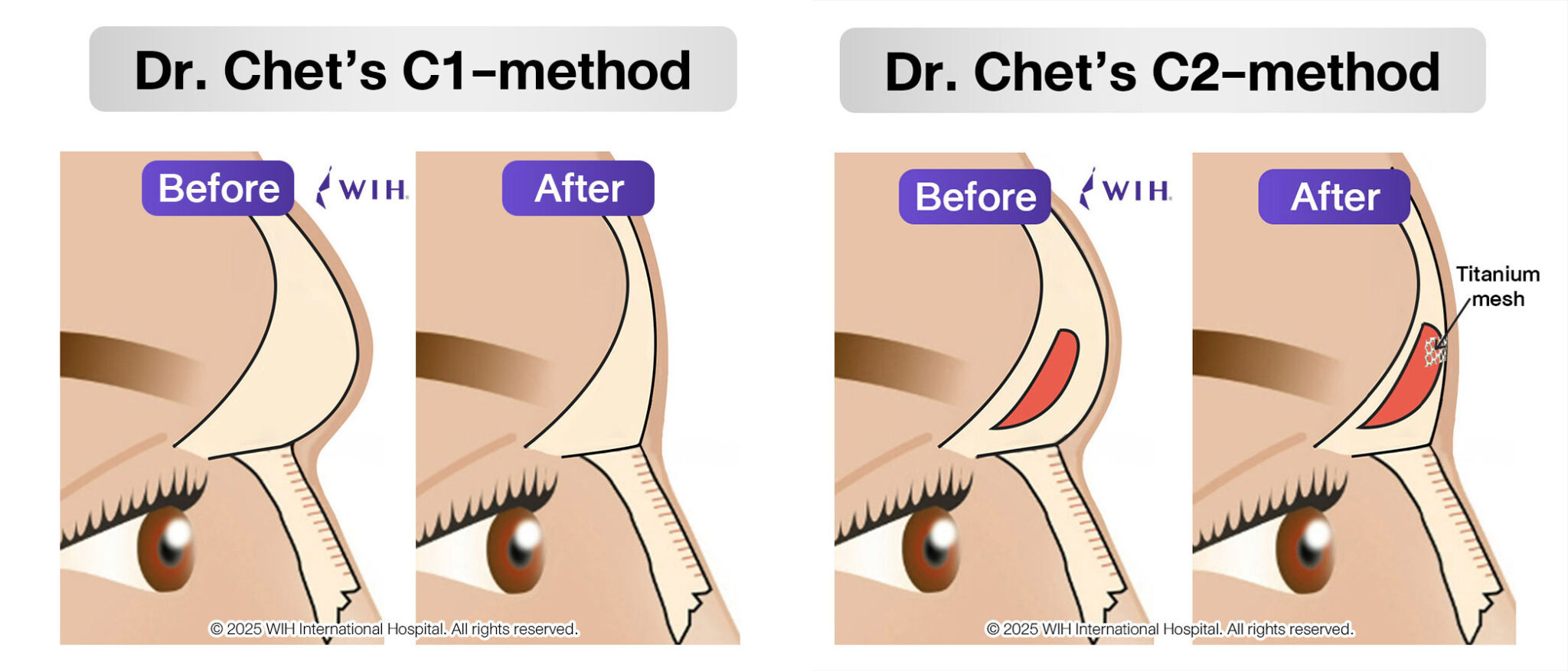 Visible Brow Ridge Brow Ridge Reduction (FFS): Frontal Sinus Setback