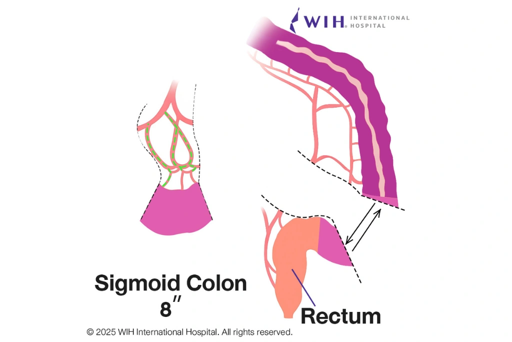 colon-vaginoplasty-wih-international-hospital