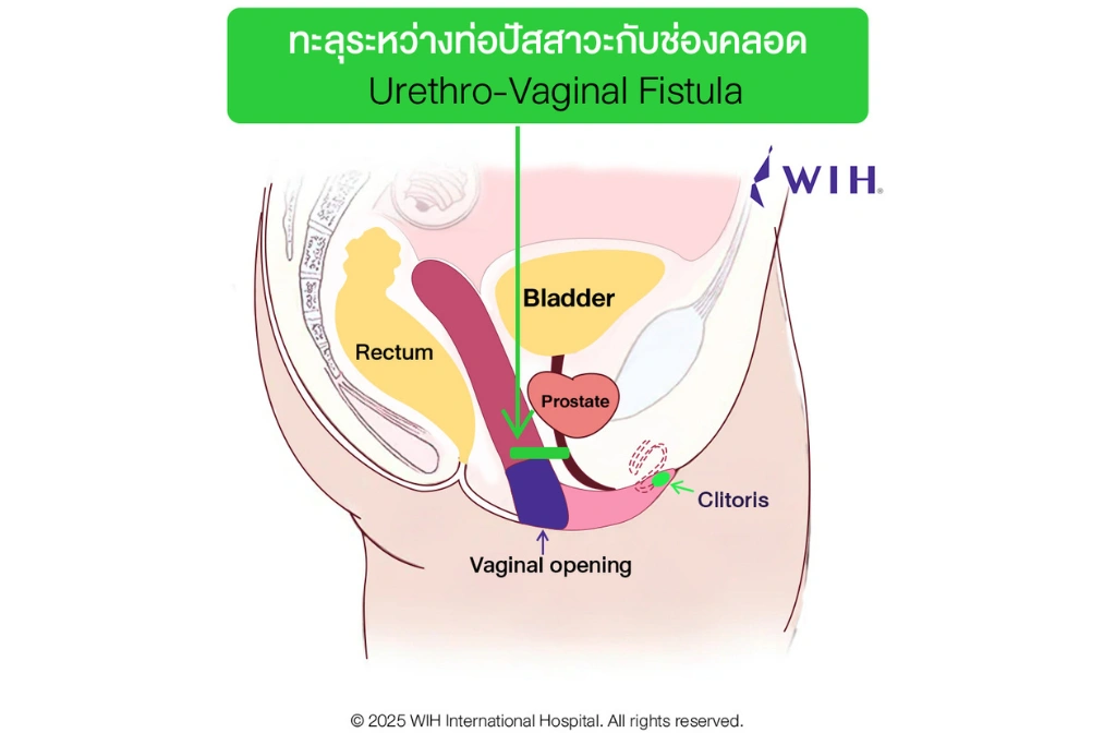 PPV-vaginoplasty-wih-international-hospial-Thailand