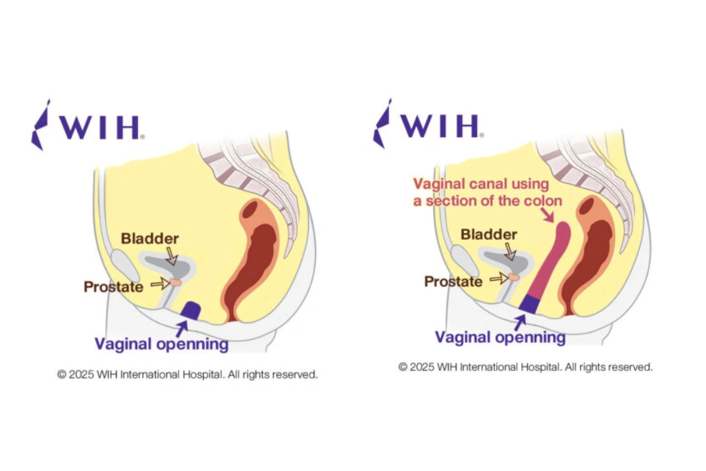 Zero Depth Vaginoplasty-wih-hospital-thailand