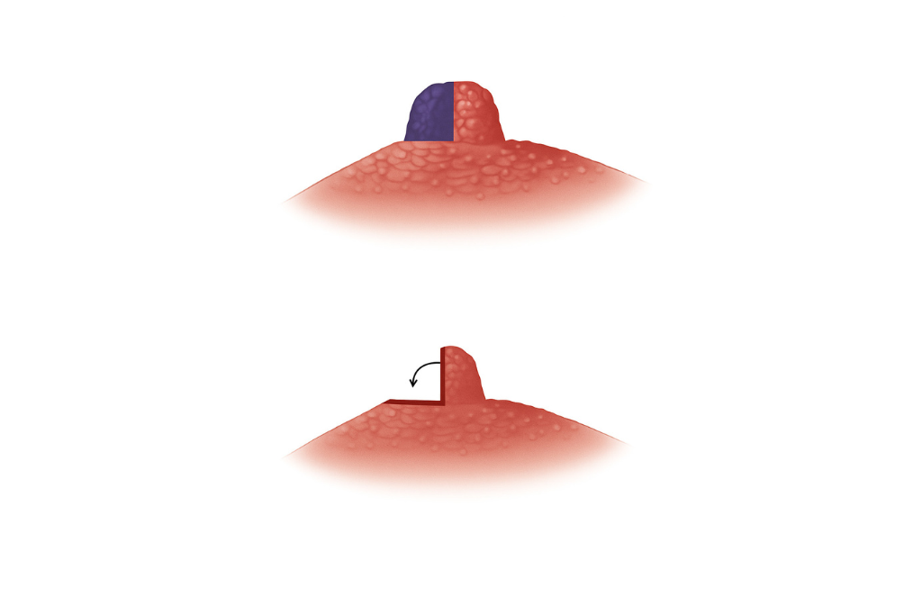 MTF Breast Augmentation Surgery-WIH Hospital, Thailand
