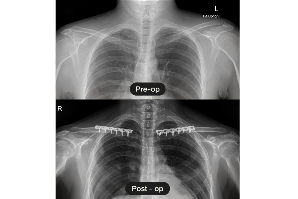 4-things-shoulder-narrowing-WIH-hospital-Thailand