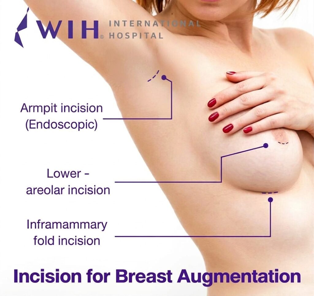 Breast Augmentation Incision Options at WIH International Hospital
