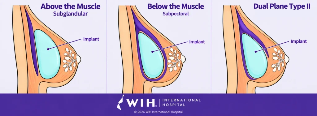 Comparison of 3 breast implant placement planes: Above the Muscle (Subglandular), Below the Muscle (Subpectoral), and Dual Plane Type II, showing muscle coverage and implant positioning.